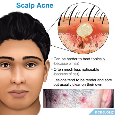 What Cause Acne On Scalp